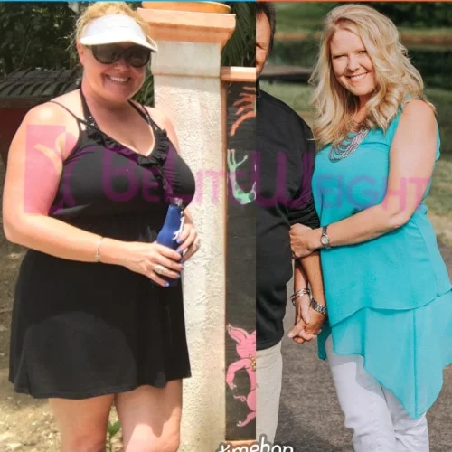 Weight Loss Surgery Before and After Colleen L - 1 Year Update*